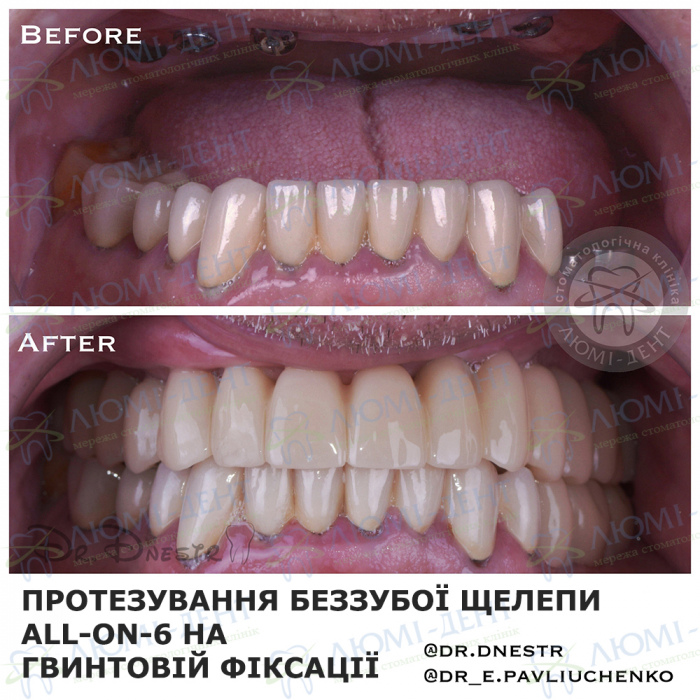 Імплантація зубів фото до і після ЛюміДент