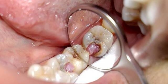 Видалення нерва із зуба фото Люмі-Дент