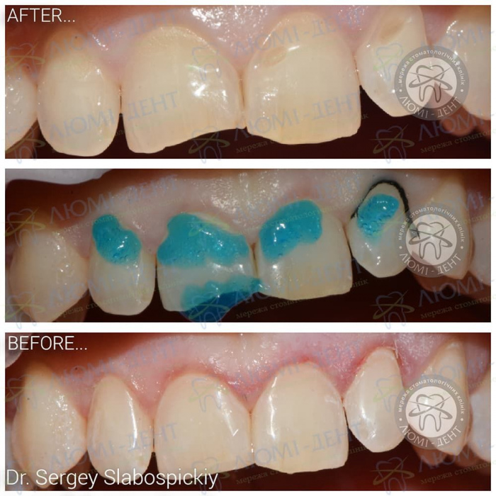 Укрепление эмали зубов в домашних условиях фото ЛюмиДент