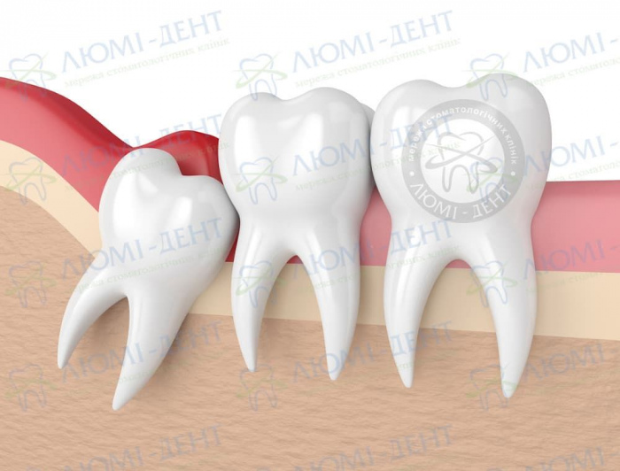 капюшон зуба мудрости фото ЛюмиДент