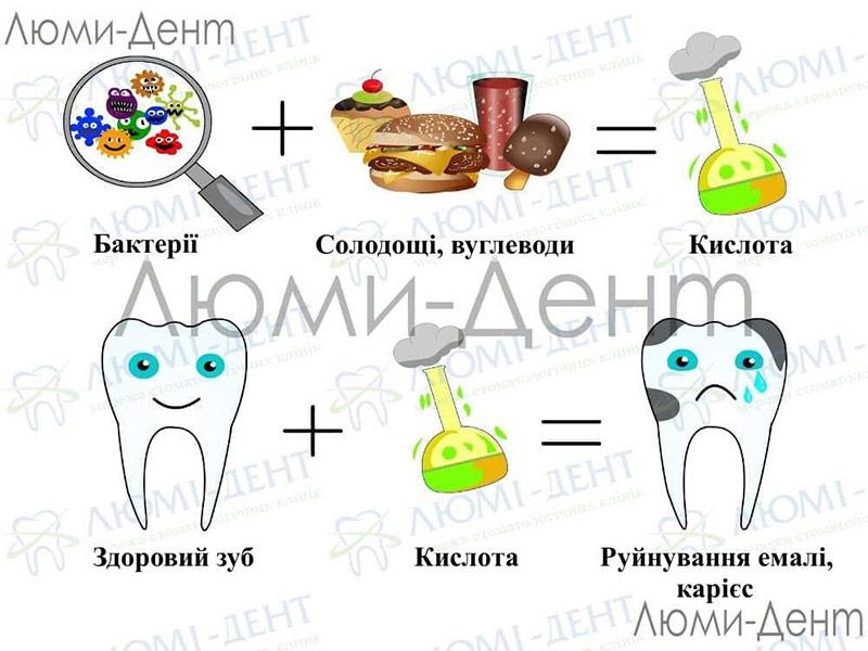 Причини виникнення карієсу Карієс фото Люмі-Дент