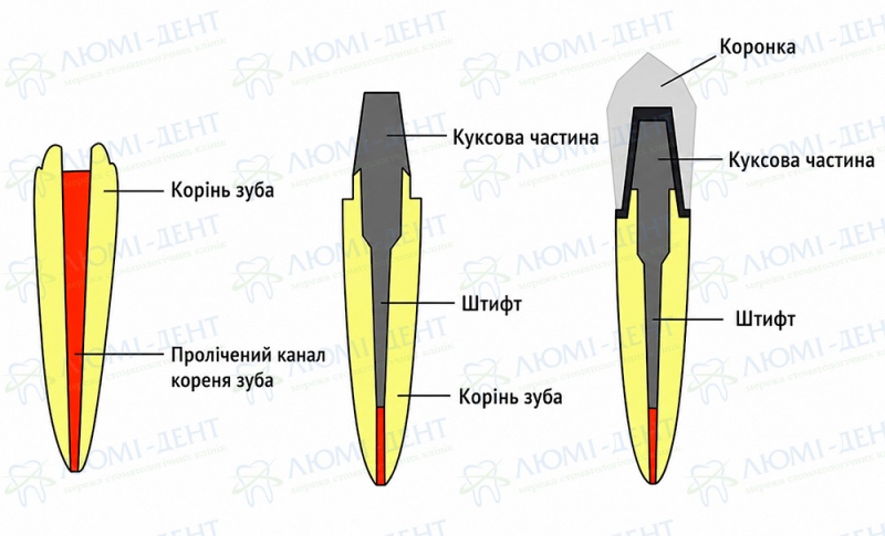 Керамічні коронки для зубів фото Люмі-Дент