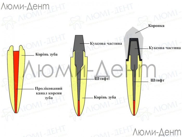 Керамічні коронки для зубів фото Люмі-Дент