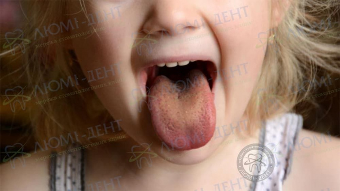 Коричневий язик у дитини фото ЛюміДент