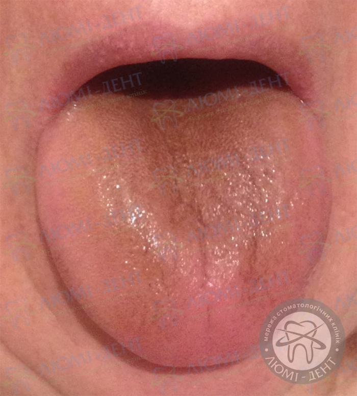 Коричневий язик фото ЛюміДент