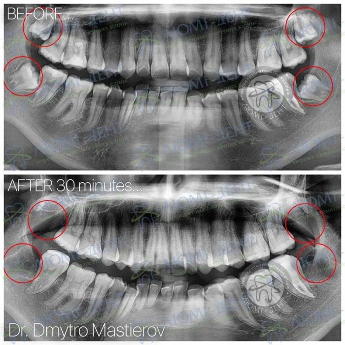 скільки зубів мудрості фото Люмі-Дент