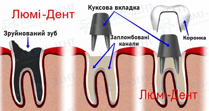 Схема виготовлення коронки на штифті Зубні коронки фото Люмі-Дент