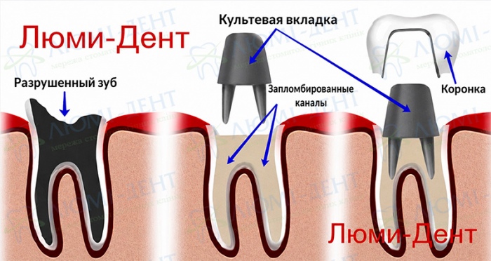 Схема изготовления коронки на штифте Коронки на зубы фото Люми-Дент
