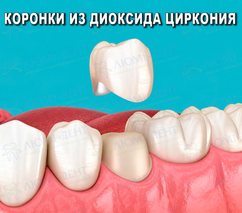 циркониевая коронка фото Люми-Дент