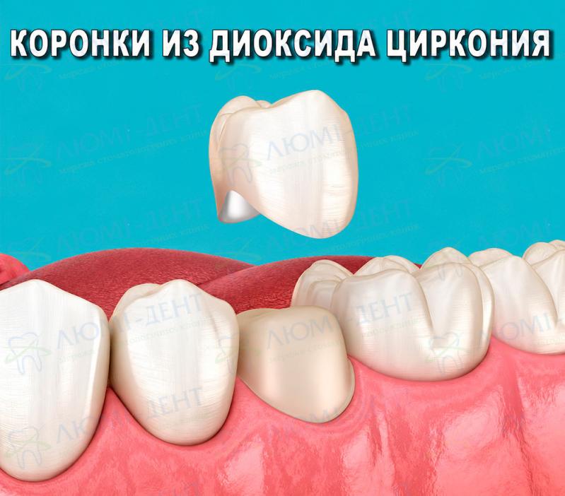 Коронки из диоксида циркония циркониевая коронка фото Люми-Дент