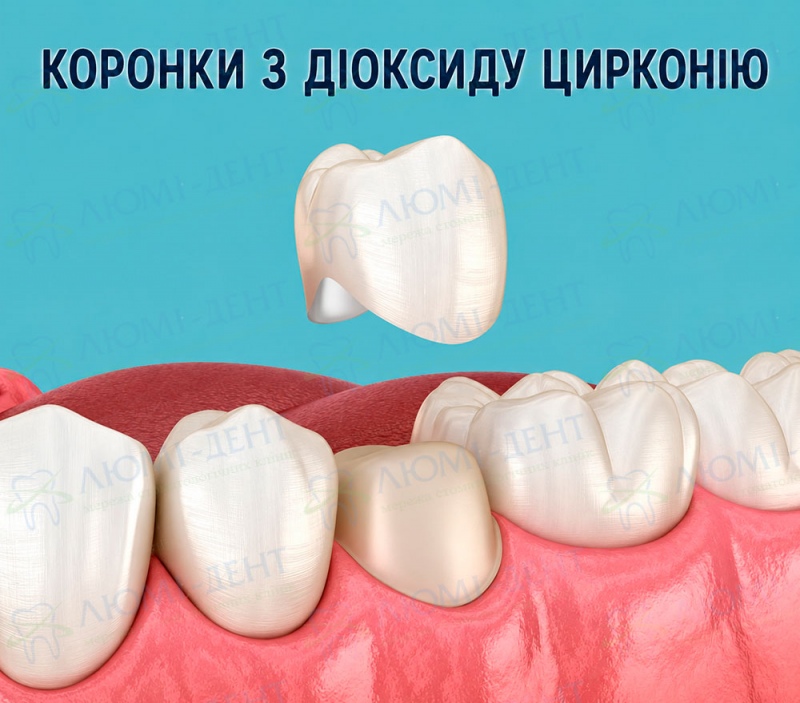цирконієва коронка фото Люмі-Дент