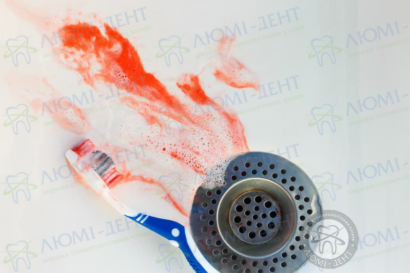 Кровоточивість ясен фото Люмідент