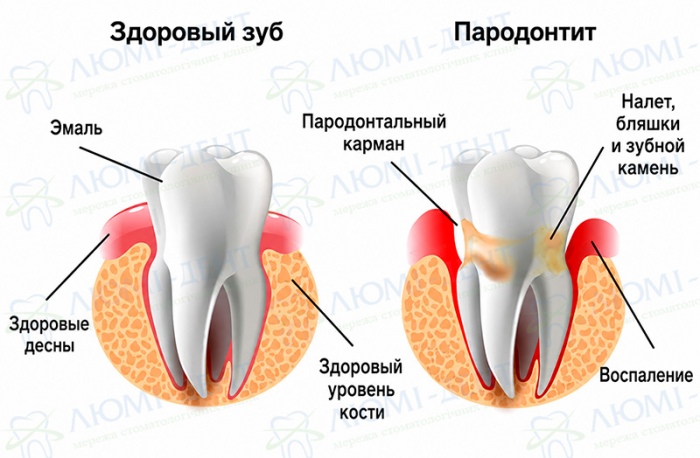 Заболевание десны Пародонтит фото ЛюмиДент
