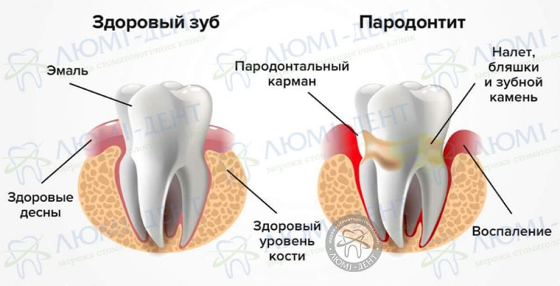 Пародонтит фото ЛюмиДент