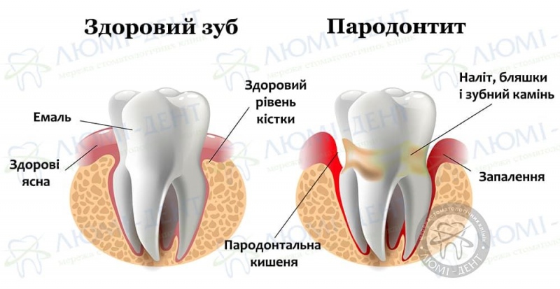 Пародонтит це фото ЛюміДент