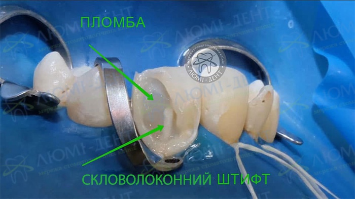 Відновлення зруйнованого зуба Київ фото Люмі-Дент