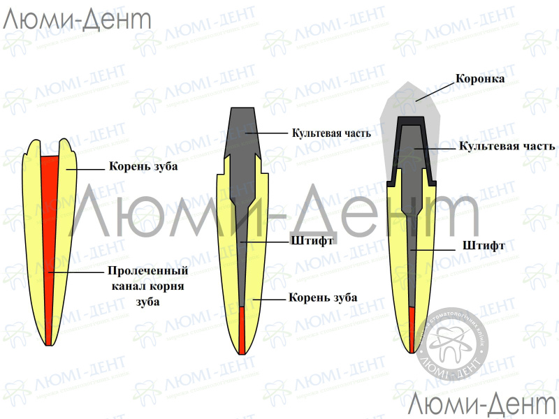 Восстановление сломанного зуба коронкой Киев фото Люми-Дент