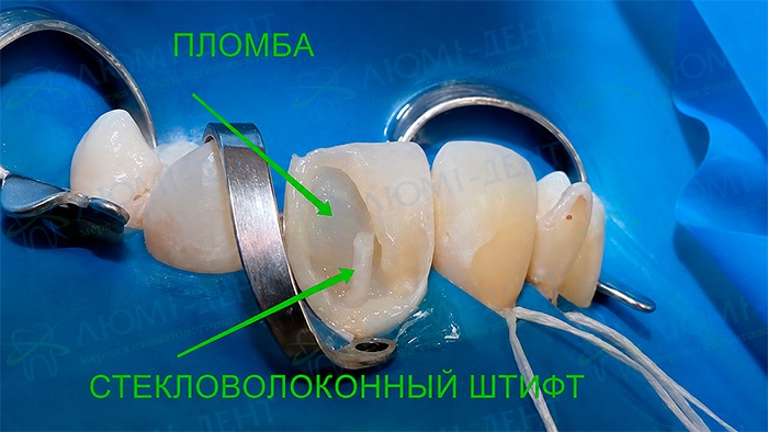 Восстановление разрушенного зуба Киев фото Люми-Дент