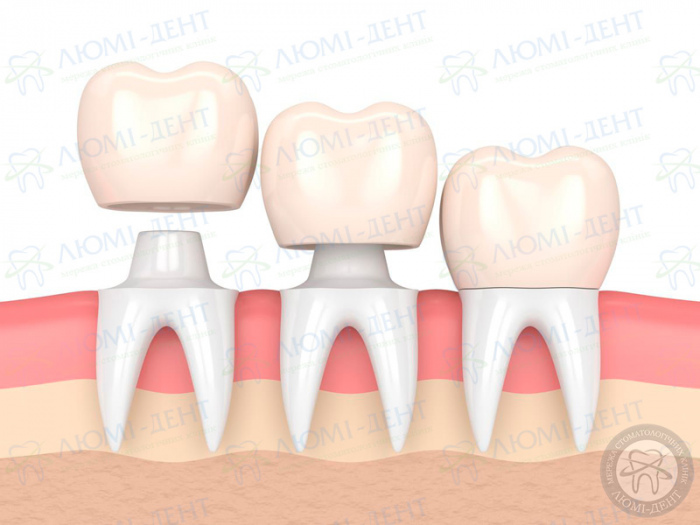 Что такое накладки на зубы фото ЛюмиДент