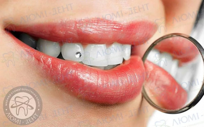 Эстетические накладки на зубы фото ЛюмиДент