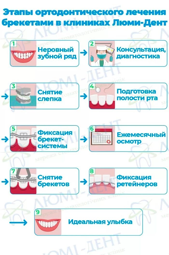 Этапы ортодонтического лечения брекетами Накладки для зубов фото Люми-Дент