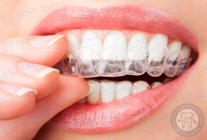 Накладки на зуби люмініри фото ЛюміДент