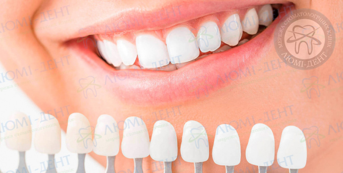 Накладки на зубы фото ЛюмиДент