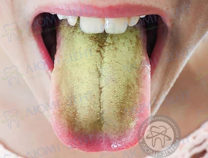 Білий наліт на язику фото Люмі-Дент