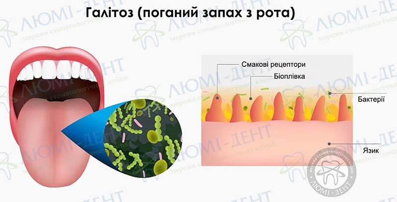 Схема утворення неприємного запаху з рота Неприємний запах з рота фото Люмі-Дент