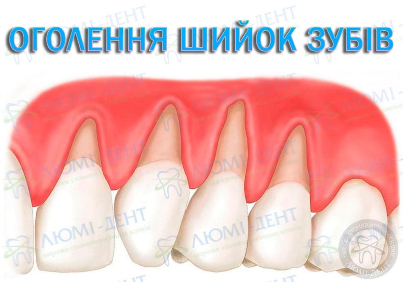 Оголення коренів зубів Оголення шийки зуба лікування фото Люмі-Дент