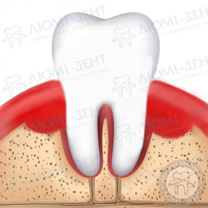 болит десна возле зуба мудрости фото ЛюмиДент