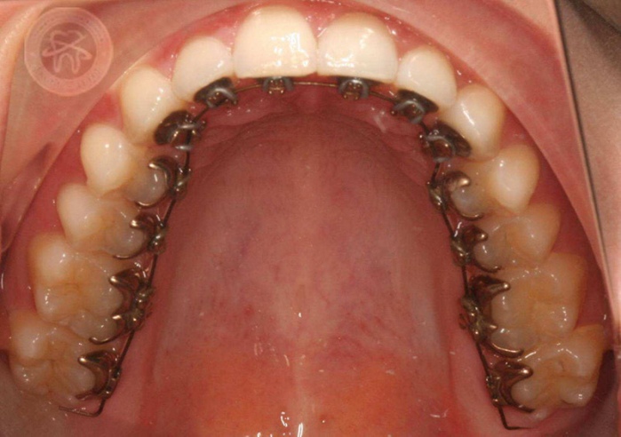 Ортодонтія Київ фото Люмі-Дент