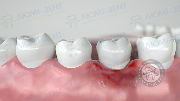 Ускладнення після імплантації верхніх зубів фото ЛюміДент