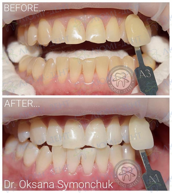 Відбілювання зубів opalescence фото ЛюміДент
