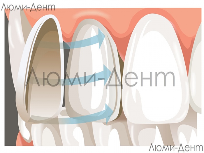 Чем отличаются виниры от коронок фото Люми-Дент