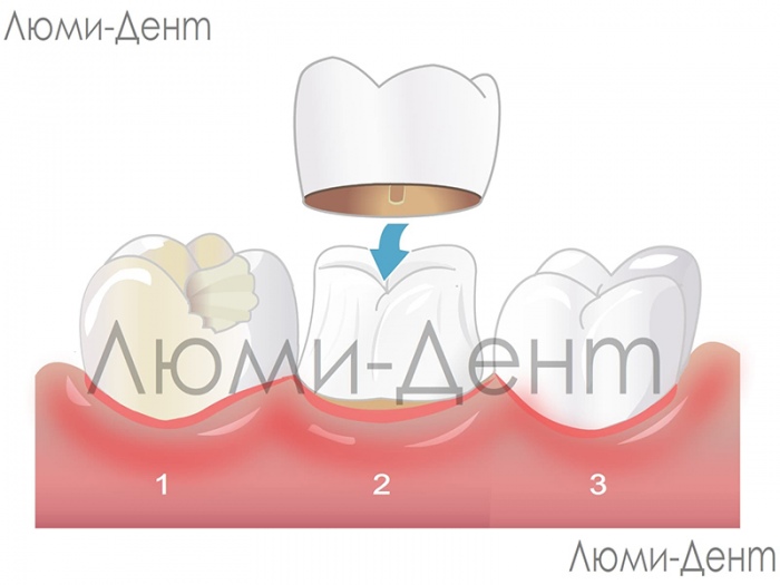 Чем отличаются виниры от коронок фото Люми-Дент