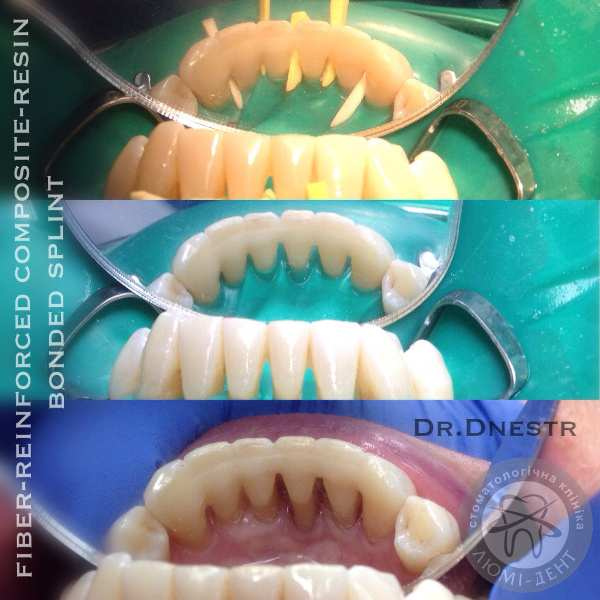 Лікування пародонтозу зубів фото ЛюміДент