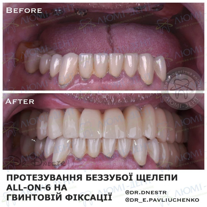 пародонтоз ясен зубів лікування фото ЛюміДент
