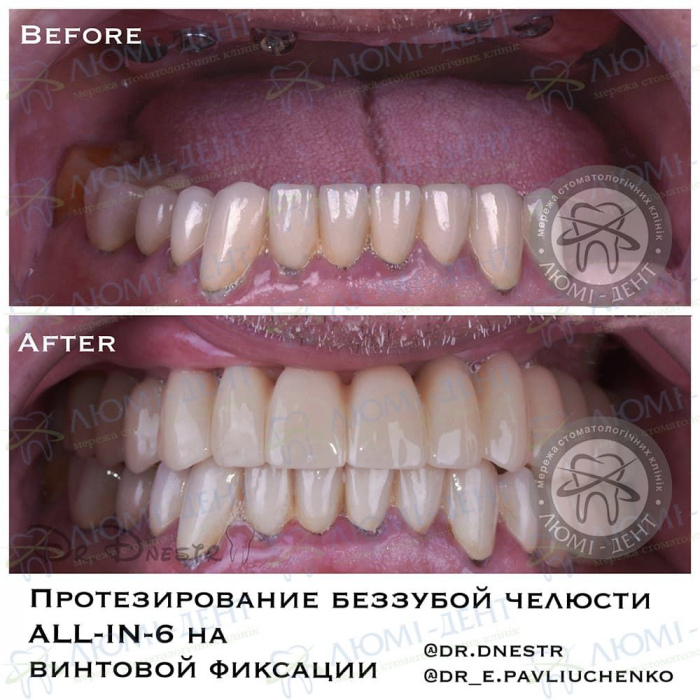 пародонтоз десен зубов лечение фото Люми-Дент