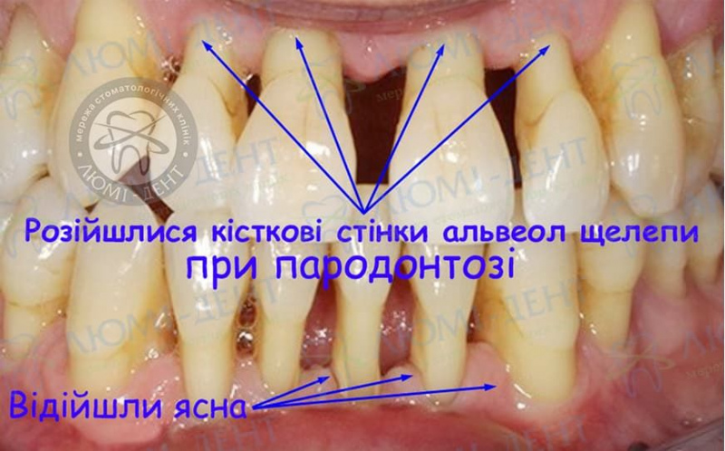 Пародонтоз зубів фото Люмідент