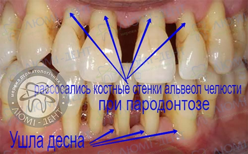 Пародонтоз зубов фото Люмидент