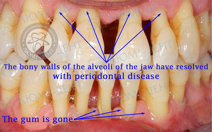 Periodontal disease of teeth photo Lumiden
