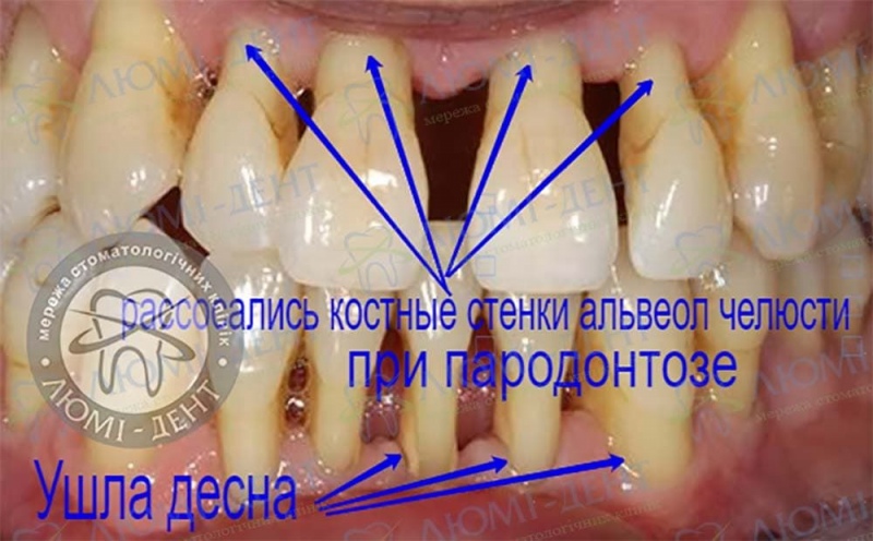 Внешние признаки пародонтоза Пародонтоз зубов фото Люми-Дент