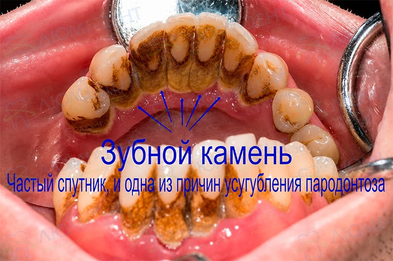 Зубной камень - частый спутник пародонтоза Причины пародонтоза десен фото Люми-Дент