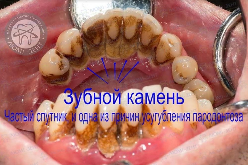 Зубной камень - частый спутник пародонтоза Причины пародонтоза десен фото Люми-Дент