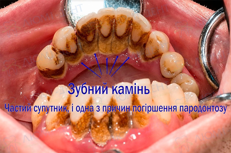 Зубний камінь - частий супутник пародонтозу Як лікувати пародонтоз фото Люмі-Дент