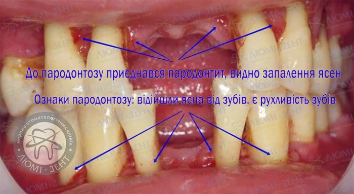 ліки від пародонтозу фото Люмі-Дент