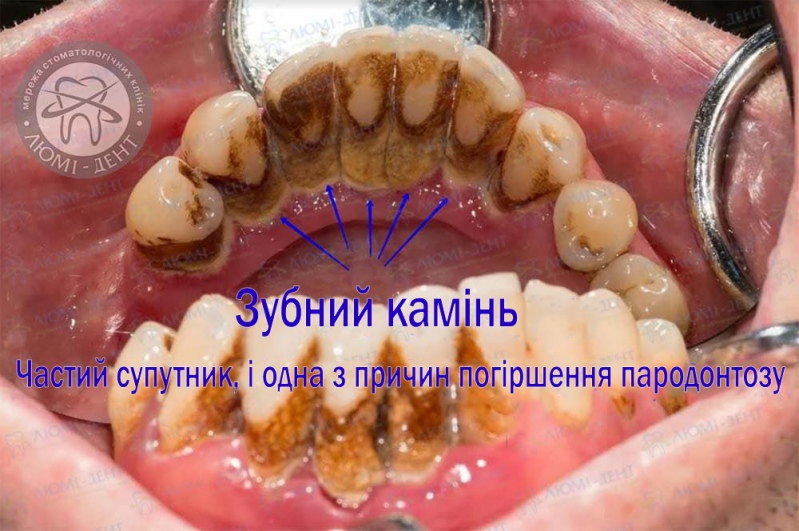 Як лікувати пародонтоз фото Люмі-Дент