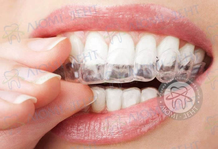 підвищена стертість зубів фото ЛюміДент