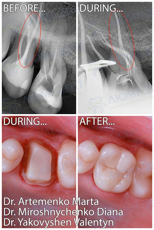 Лікування апікального періодонтиту зуба 1.6 лікар Артеменко Марта